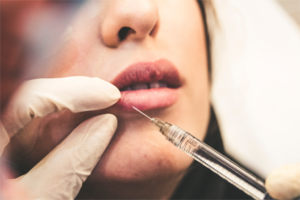 A woman getting her lips filled with botox.